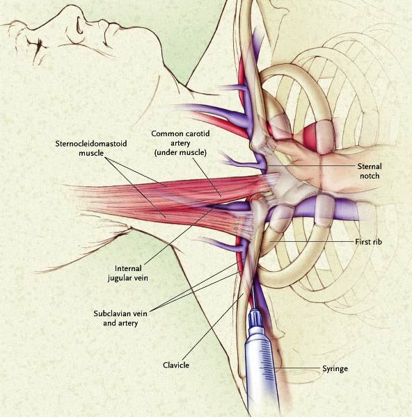 Постановка яремного катетера схема у взрослых