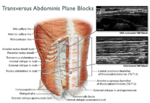 анатомия передней брюшной стенки при TAP-блоке